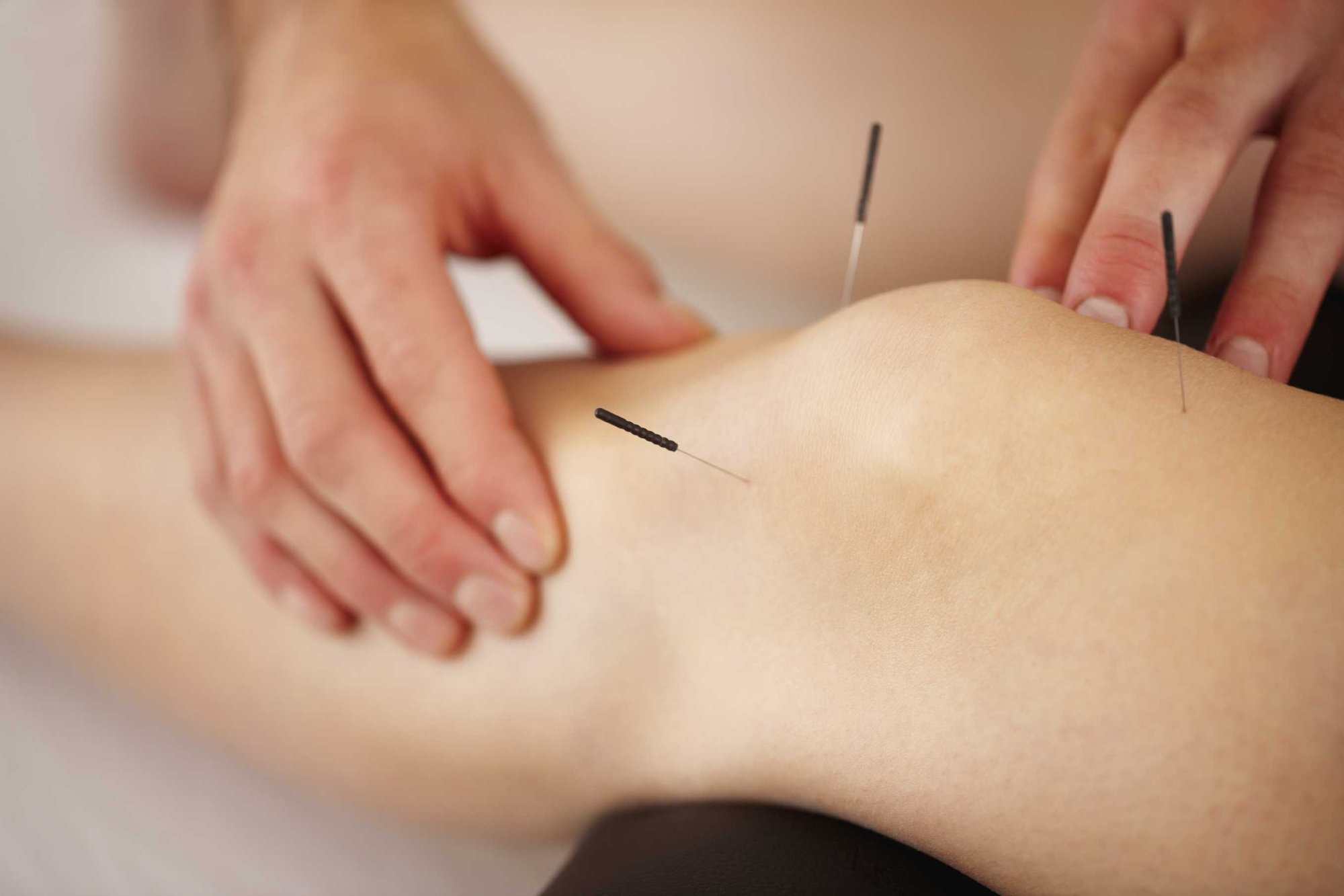 Acupuncture and hands-on physiotherapy treatment